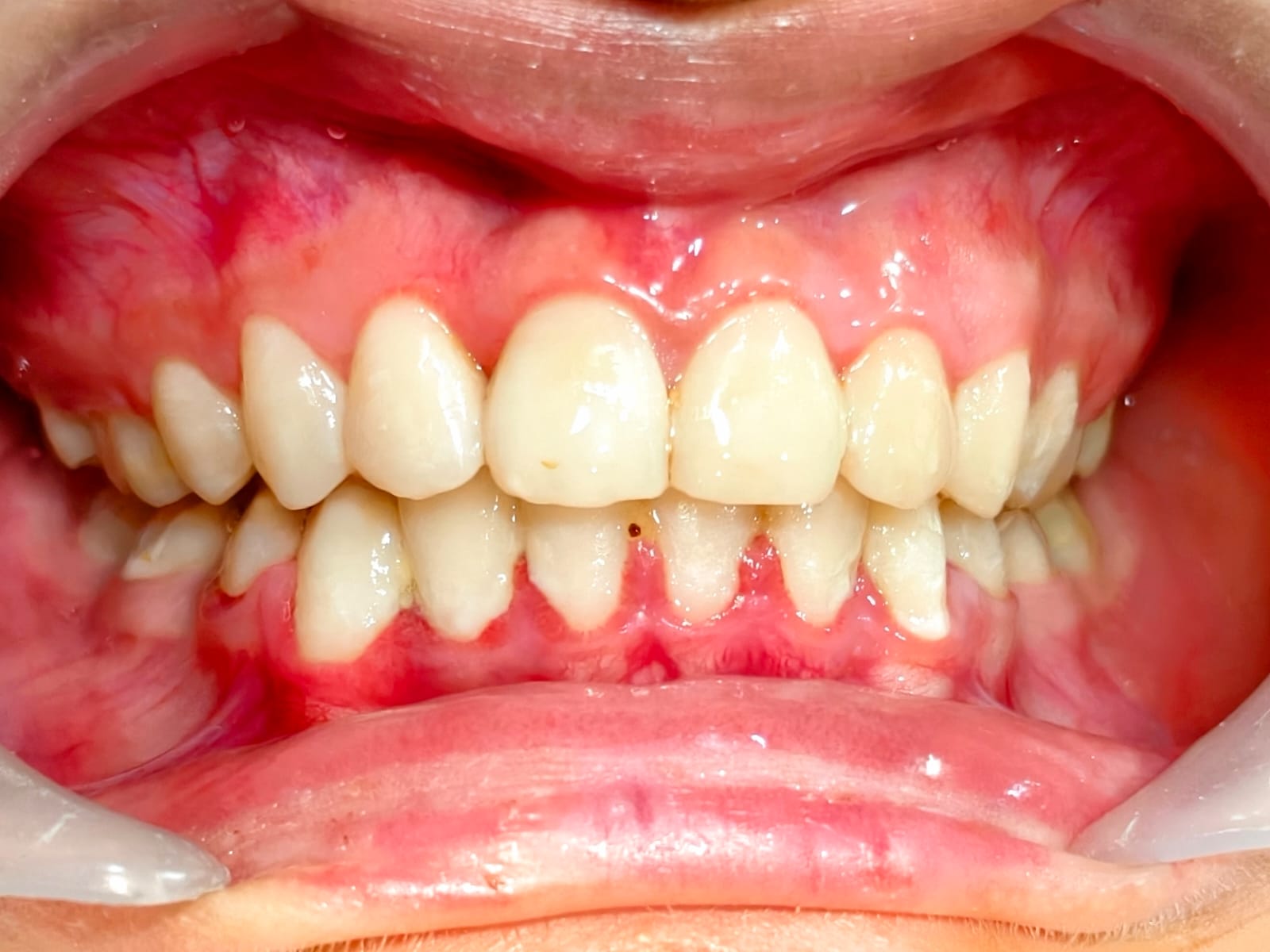 Well-aligned, even upper and lower teeth after braces treatment