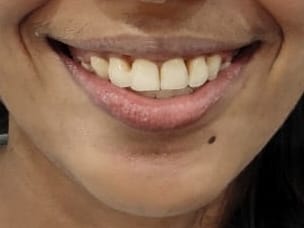 Patient smile after cosmetic treatment