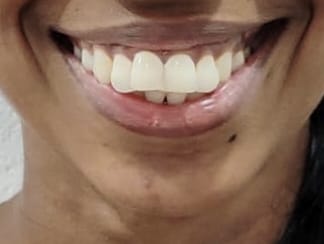 Patient smile before cosmetic treatment